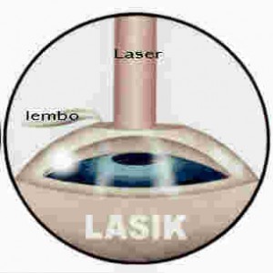 lasik