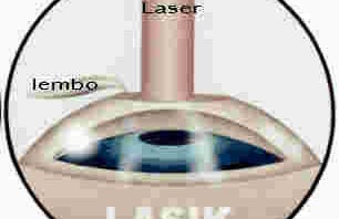 Intervista: una brutta esperienza con il laser